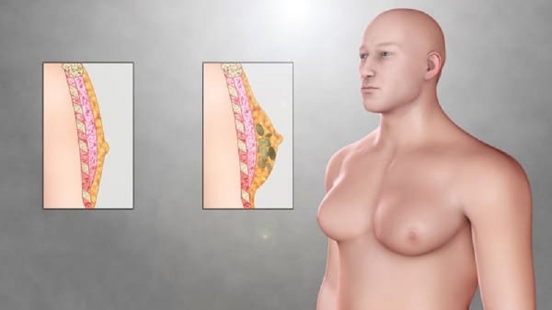 How Much Does a Gynecomastia Surgery Cost?